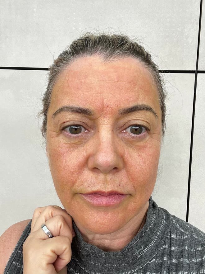 Rosto de frente antes do tratamento, com flacidez no terço inferior