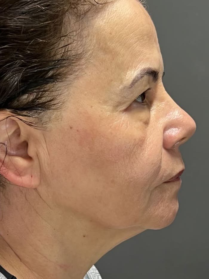 Perfil do mesmo rosto depois do tratamento