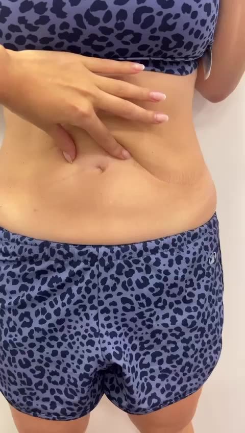 Paciente segurando a gordura localizada do abdômen